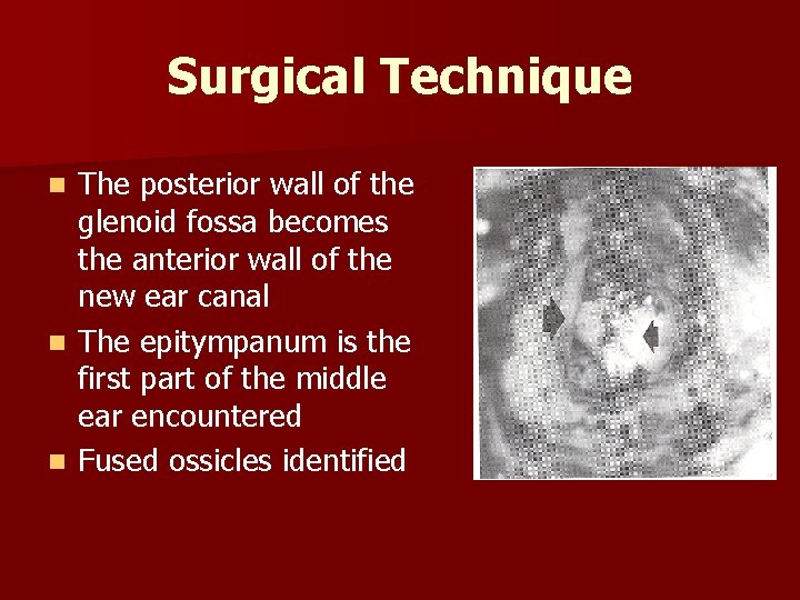 Surgical Technique The posterior wall of the glenoid fossa becomes the anterior wall of