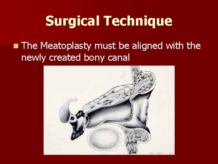Surgical Technique n The Meatoplasty must be aligned with the newly created bony canal