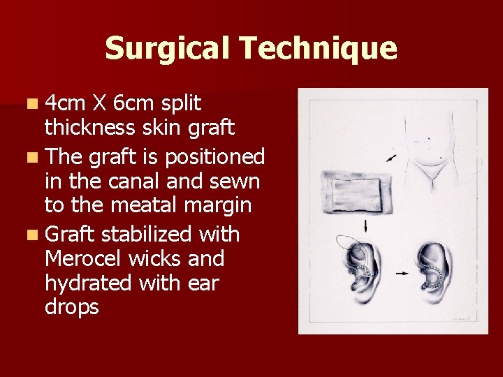 Surgical Technique n 4 cm X 6 cm split thickness skin graft n The