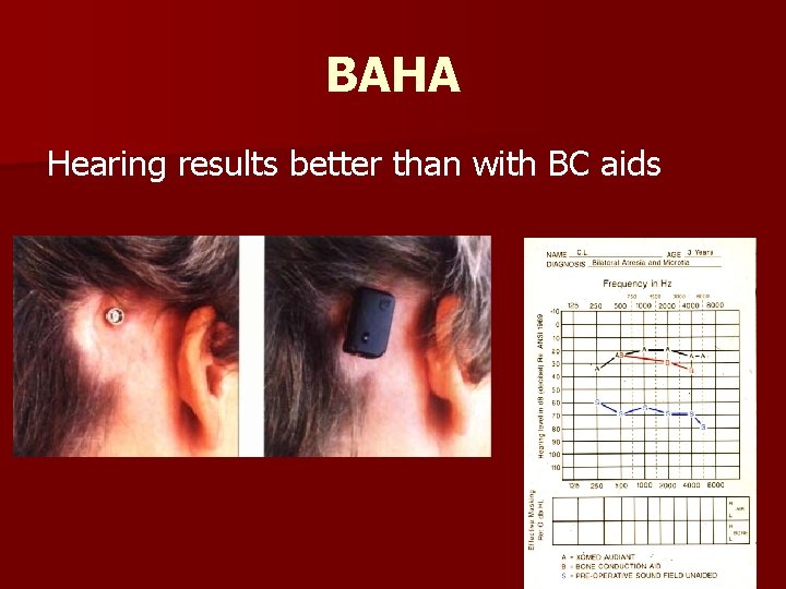 BAHA Hearing results better than with BC aids 