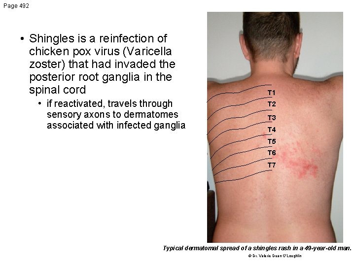 Page 492 • Shingles is a reinfection of chicken pox virus (Varicella zoster) that