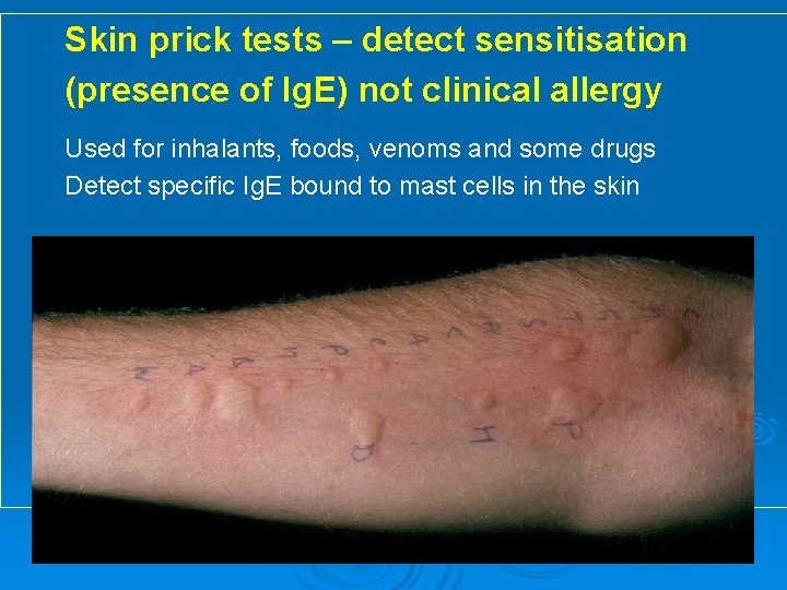 Skin prick tests – detect sensitisation (presence of Ig. E) not clinical allergy Used
