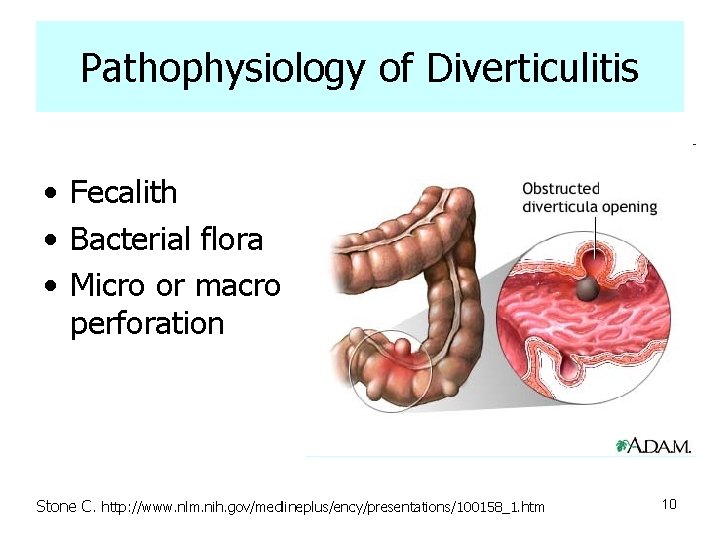 Pathophysiology of Diverticulitis • Fecalith • Bacterial flora • Micro or macro perforation Stone