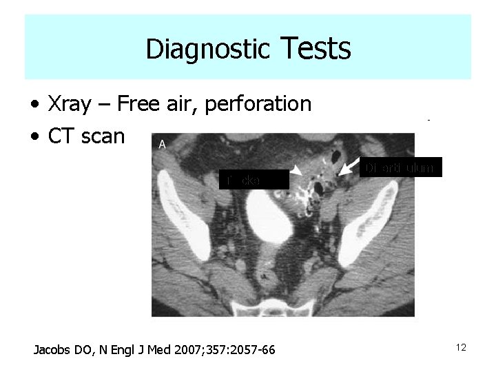 Diagnostic Tests • Xray – Free air, perforation • CT scan Thickening Jacobs DO,