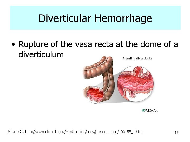 Diverticular Hemorrhage • Rupture of the vasa recta at the dome of a diverticulum