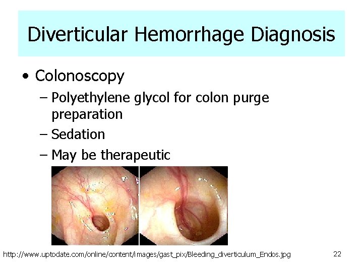 Diverticular Hemorrhage Diagnosis • Colonoscopy – Polyethylene glycol for colon purge preparation – Sedation