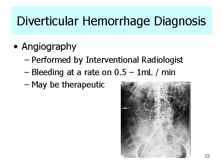 Diverticular Hemorrhage Diagnosis • Angiography – Performed by Interventional Radiologist – Bleeding at a