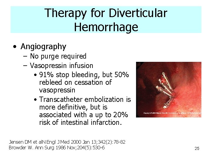 Therapy for Diverticular Hemorrhage • Angiography – No purge required – Vasopressin infusion •