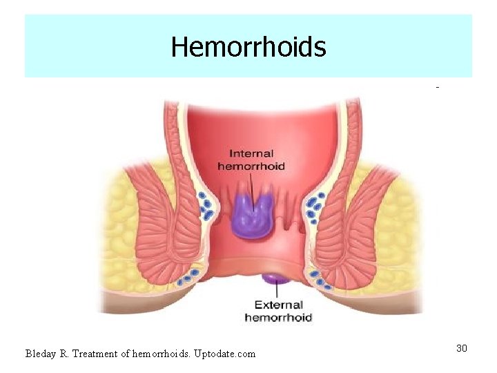 Hemorrhoids Bleday R. Treatment of hemorrhoids. Uptodate. com 30 