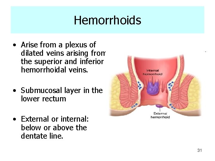 Hemorrhoids • Arise from a plexus of dilated veins arising from the superior and