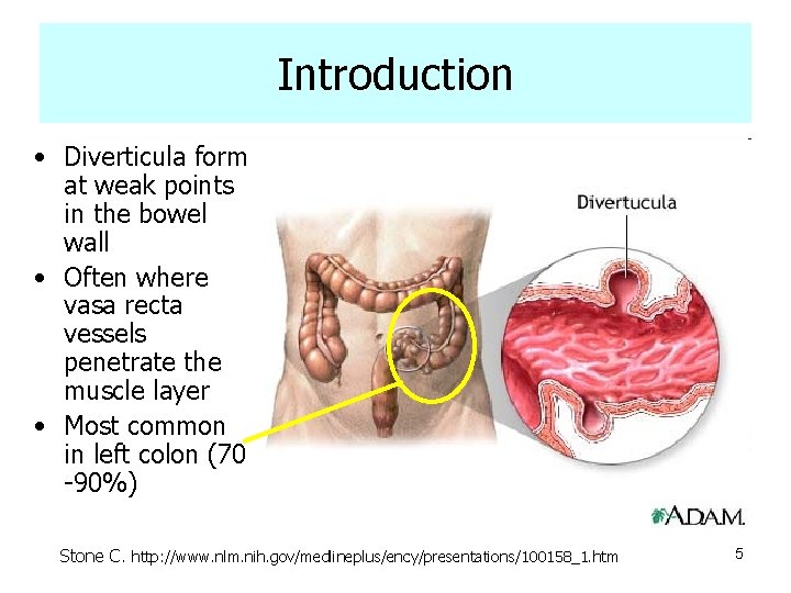 Introduction • Diverticula form at weak points in the bowel wall • Often where