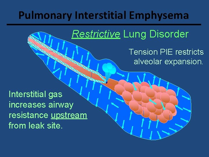 Pulmonary Interstitial Emphysema Restrictive Lung Disorder Tension PIE restricts alveolar expansion. Interstitial gas increases