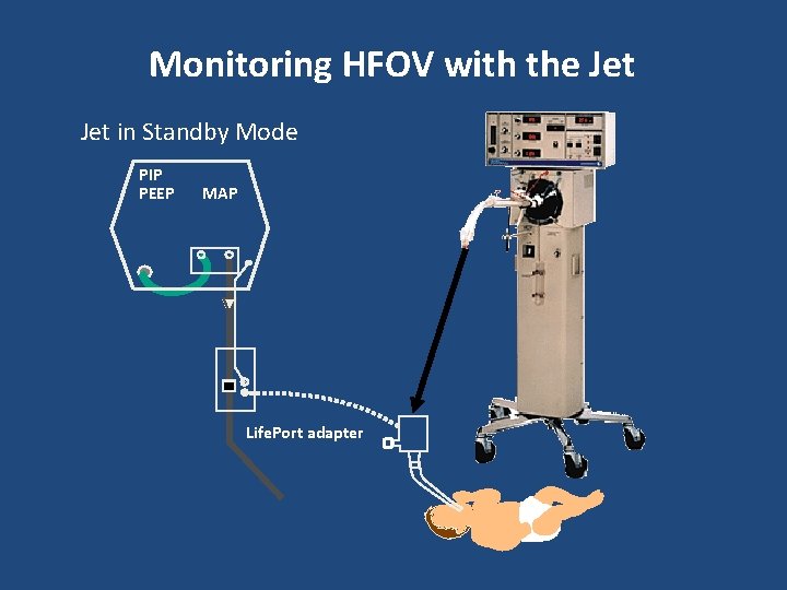Monitoring HFOV with the Jet in Standby Mode PIP PEEP MAP Life. Port adapter