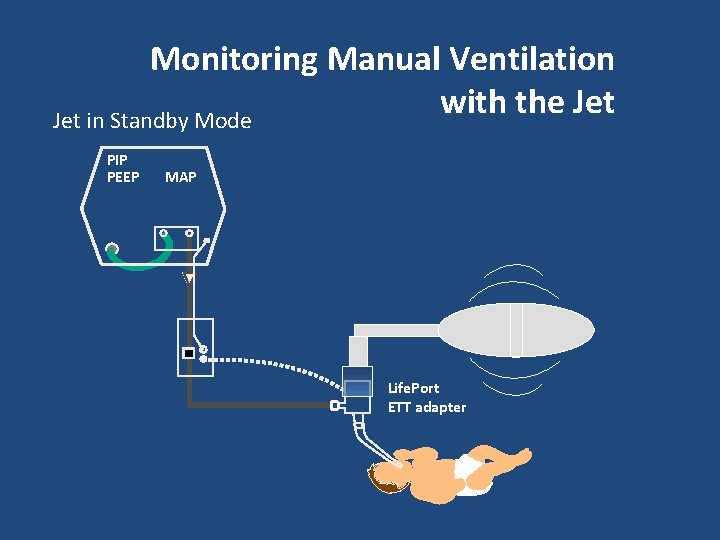 Monitoring Manual Ventilation with the Jet in Standby Mode PIP PEEP MAP Life. Port