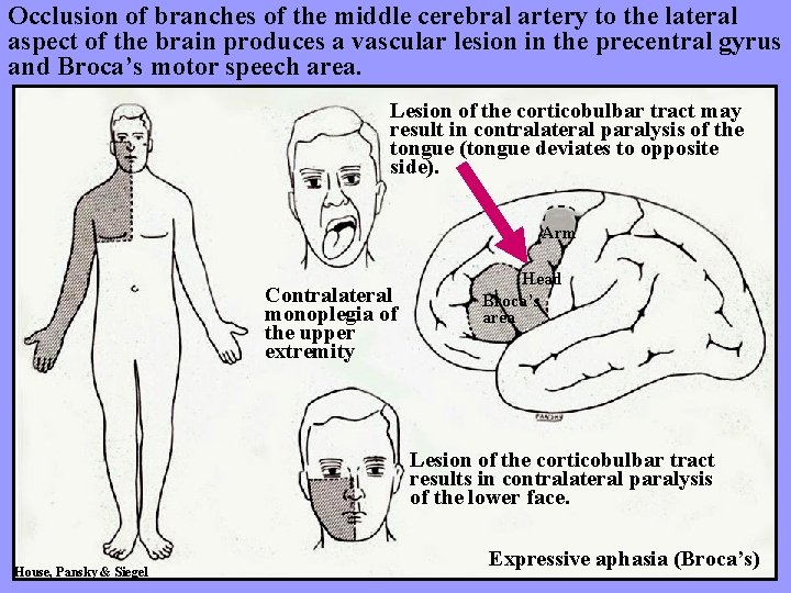 Occlusion of branches of the middle cerebral artery to the lateral aspect of the