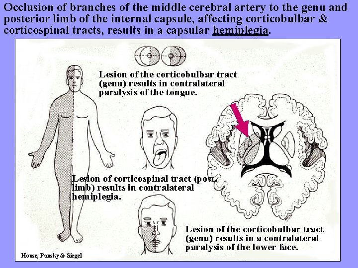 Occlusion of branches of the middle cerebral artery to the genu and posterior limb