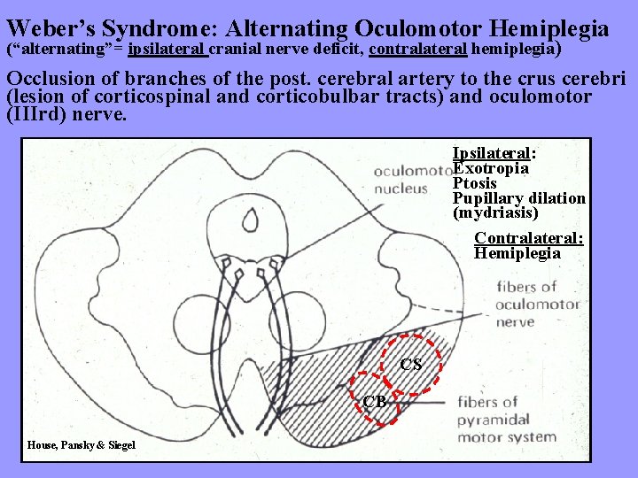 Weber’s Syndrome: Alternating Oculomotor Hemiplegia (“alternating”= ipsilateral cranial nerve deficit, contralateral hemiplegia) Occlusion of