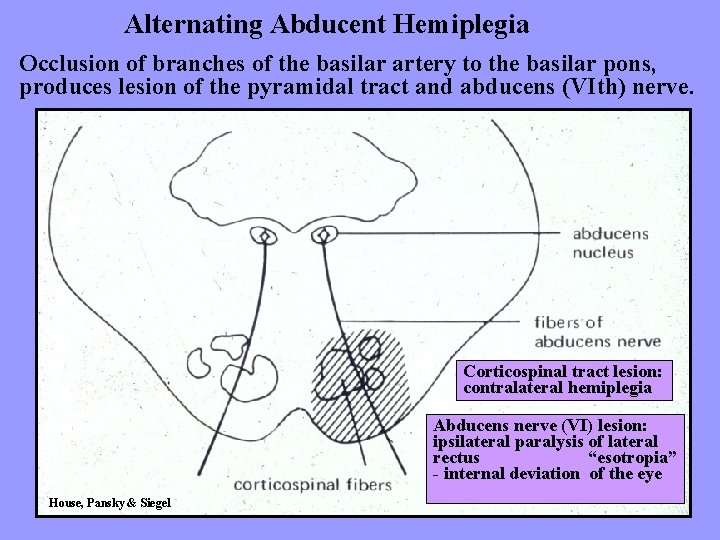 Alternating Abducent Hemiplegia Occlusion of branches of the basilar artery to the basilar pons,