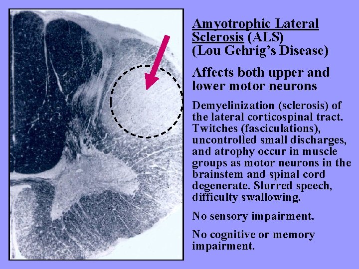 Amyotrophic Lateral Sclerosis (ALS) (Lou Gehrig’s Disease) Affects both upper and lower motor neurons
