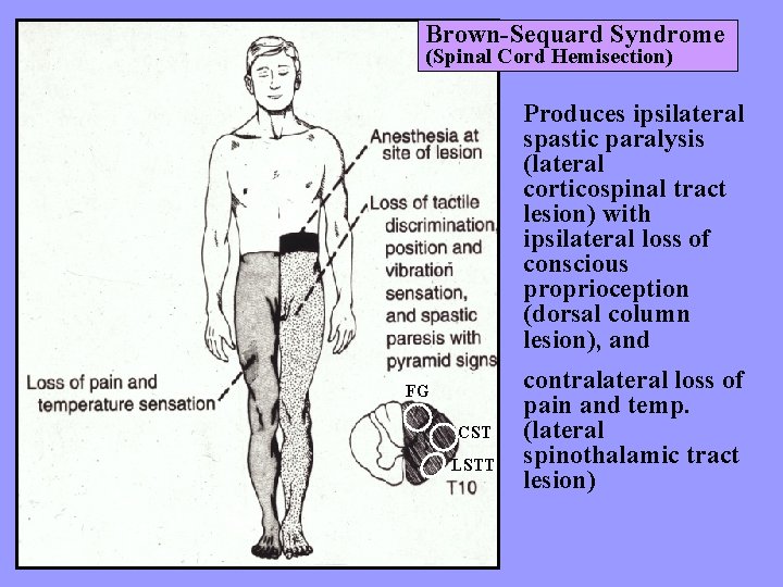 Brown-Sequard Syndrome (Spinal Cord Hemisection) Produces ipsilateral spastic paralysis (lateral corticospinal tract lesion) with