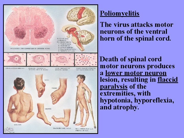 Poliomyelitis The virus attacks motor neurons of the ventral horn of the spinal cord.