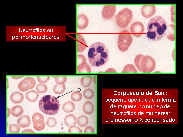 Neutrófilos ou polimorfonucleares Corpúsculo de Barr: pequeno apêndice em forma de raquete no núcleo
