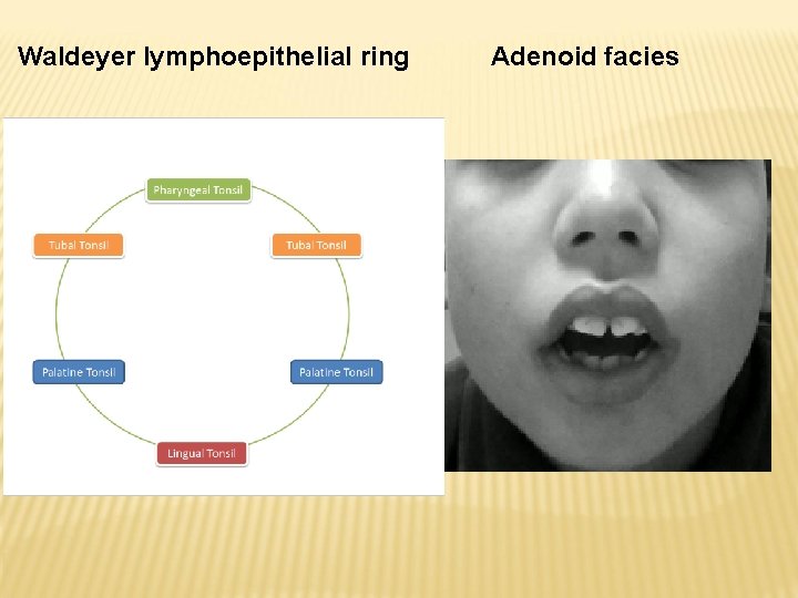 Waldeyer lymphoepithelial ring Adenoid facies 