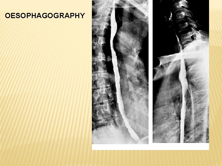 OESOPHAGOGRAPHY 