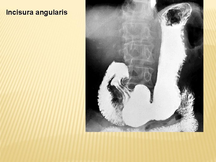Incisura angularis 
