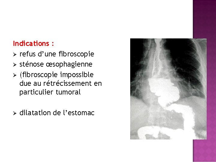 Indications : Ø refus d’une fibroscopie Ø sténose œsophagienne Ø (fibroscopie impossible due au
