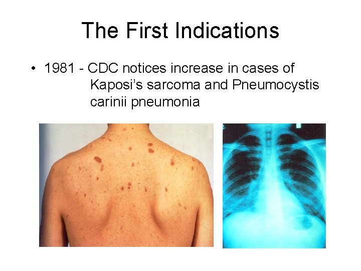 The First Indications • 1981 - CDC notices increase in cases of Kaposi’s sarcoma
