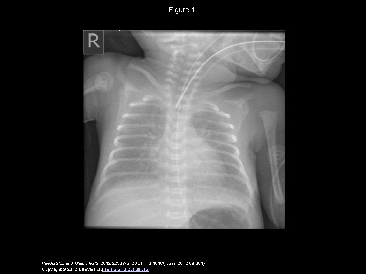 Figure 1 Paediatrics and Child Health 2012 22507 -512 DOI: (10. 1016/j. paed. 2012.