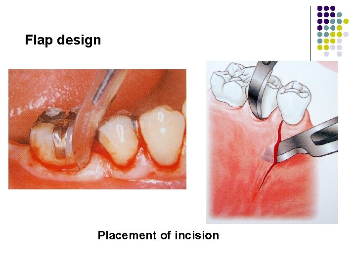 Flap design Placement of incision 