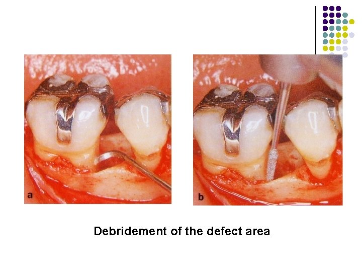 Debridement of the defect area 