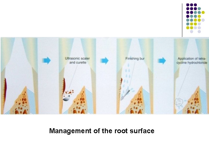 Management of the root surface 