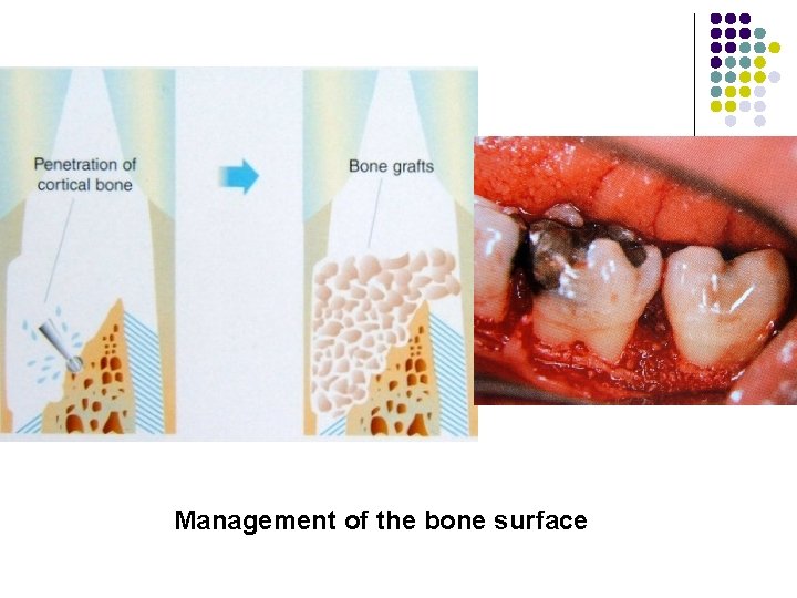 Management of the bone surface 