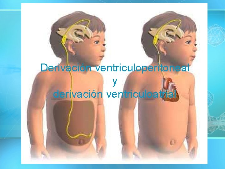 Derivación ventriculoperitoneal y derivación ventriculoatrial 