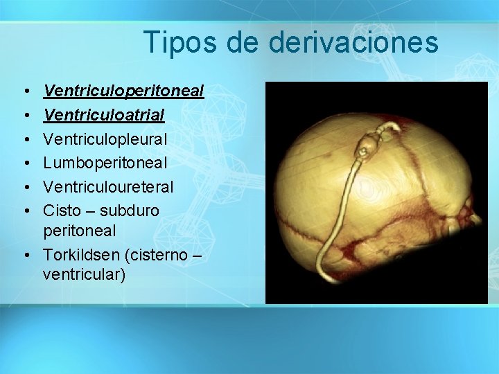 Tipos de derivaciones • • • Ventriculoperitoneal Ventriculoatrial Ventriculopleural Lumboperitoneal Ventriculoureteral Cisto – subduro