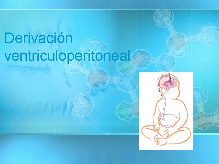 Derivación ventriculoperitoneal 