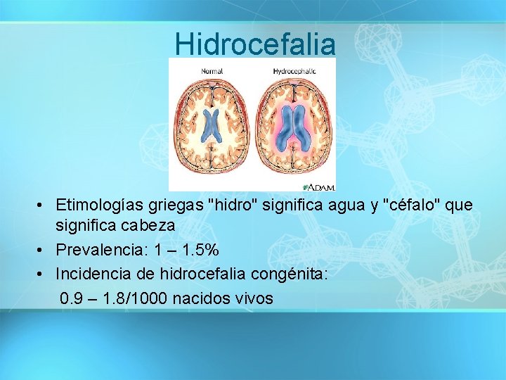 Hidrocefalia • Etimologías griegas "hidro" significa agua y "céfalo" que significa cabeza • Prevalencia: