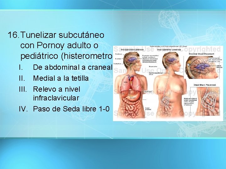 16. Tunelizar subcutáneo con Pornoy adulto o pediátrico (histerometro) I. De abdominal a craneal