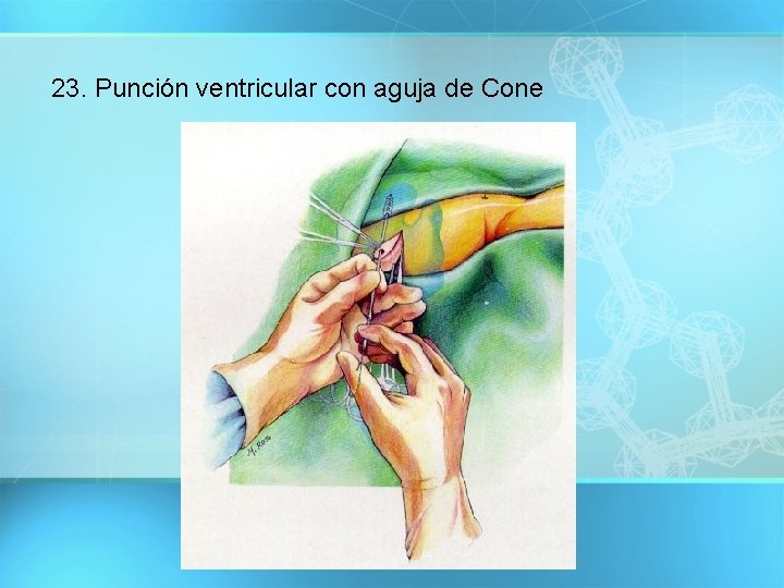 23. Punción ventricular con aguja de Cone 