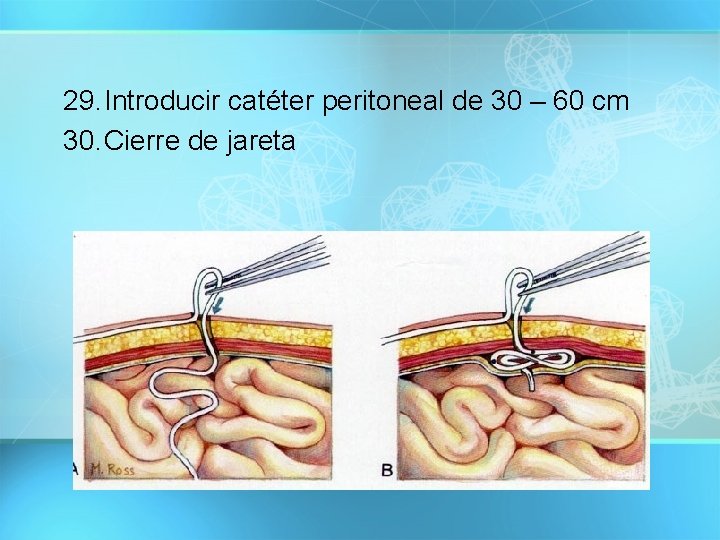 29. Introducir catéter peritoneal de 30 – 60 cm 30. Cierre de jareta 