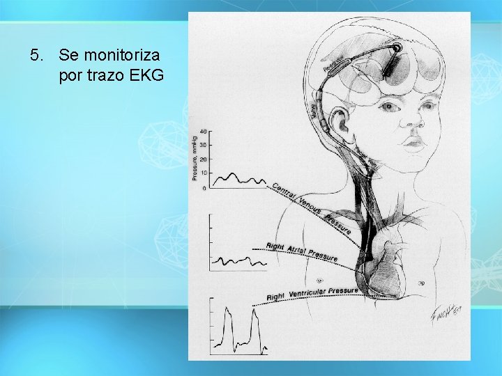 5. Se monitoriza por trazo EKG 