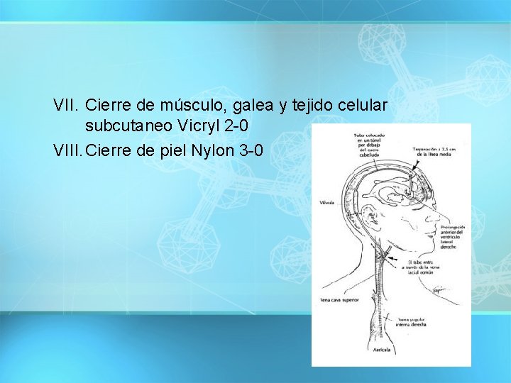 VII. Cierre de músculo, galea y tejido celular subcutaneo Vicryl 2 -0 VIII. Cierre