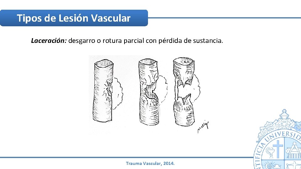 Tipos de Lesión Vascular Laceración: desgarro o rotura parcial con pérdida de sustancia. Trauma Tipos de Lesión Vascular Laceración: desgarro o rotura parcial con pérdida de sustancia. Trauma