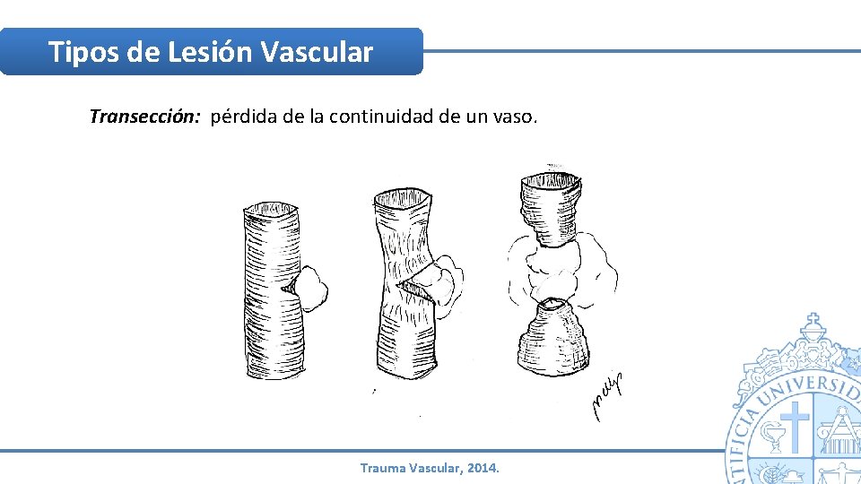 Tipos de Lesión Vascular Transección: pérdida de la continuidad de un vaso. Trauma Vascular, Tipos de Lesión Vascular Transección: pérdida de la continuidad de un vaso. Trauma Vascular,