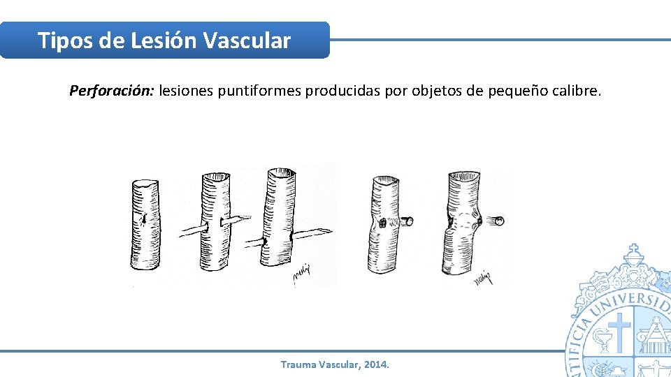 Tipos de Lesión Vascular Perforación: lesiones puntiformes producidas por objetos de pequeño calibre. Trauma Tipos de Lesión Vascular Perforación: lesiones puntiformes producidas por objetos de pequeño calibre. Trauma