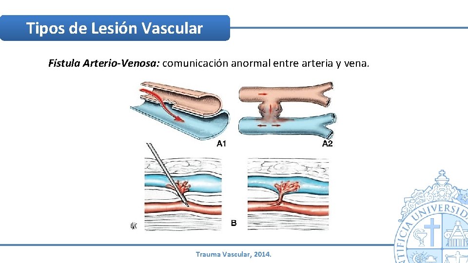 Tipos de Lesión Vascular Fístula Arterio-Venosa: comunicación anormal entre arteria y vena. Trauma Vascular, Tipos de Lesión Vascular Fístula Arterio-Venosa: comunicación anormal entre arteria y vena. Trauma Vascular,