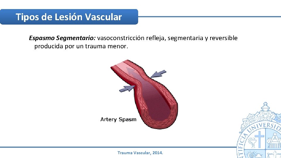 Tipos de Lesión Vascular Espasmo Segmentario: vasoconstricción refleja, segmentaria y reversible producida por un Tipos de Lesión Vascular Espasmo Segmentario: vasoconstricción refleja, segmentaria y reversible producida por un